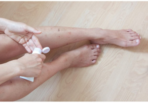 עקיצה ממדוזה