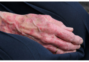 מחלת עור בגיל המבוגר