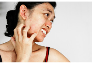 אבחון וטיפול אקנה