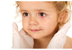 מחלה שפוגעת גם בילדים: סקלרודרמה